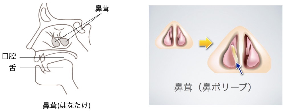 鼻茸(ポリープ)