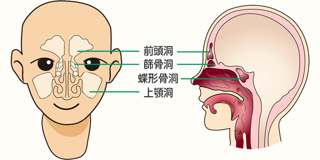 慢性副鼻腔炎