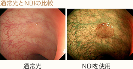 急性中耳炎の症状