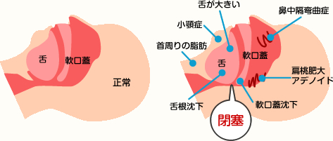 睡眠時無呼吸症候群の原因