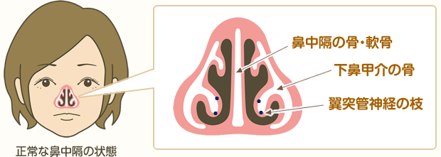 正常な鼻中隔の状態