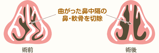 鼻中隔弯曲症の治療（鼻中隔矯正術）