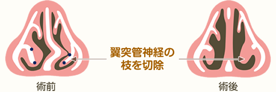 経鼻腔的翼突管神経切除術